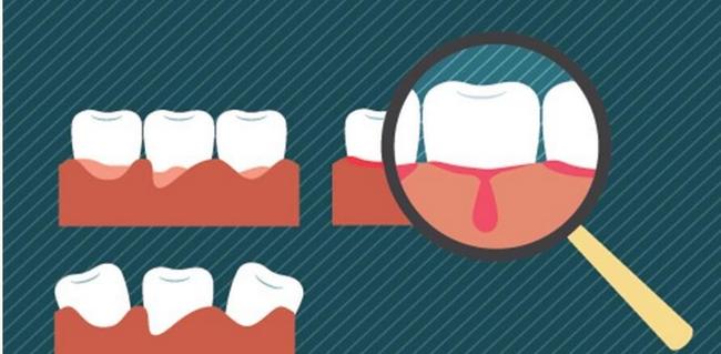 牙龈出血怎么解决?