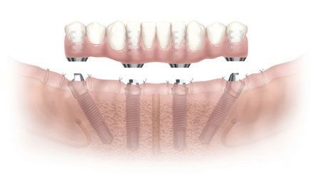 种牙最好的医院 12-1Q2201J51c47.jpg