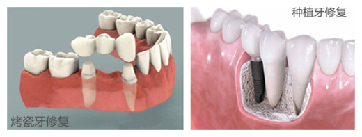 烤瓷牙和种植牙修复的效果