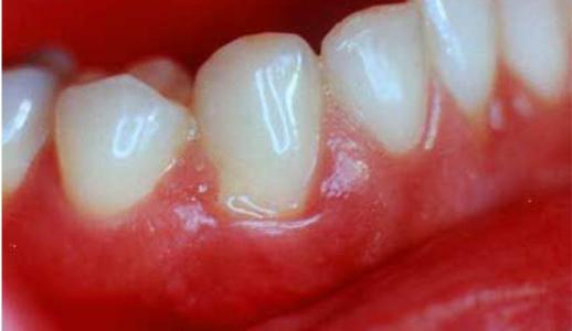 牙龈炎怎么治？