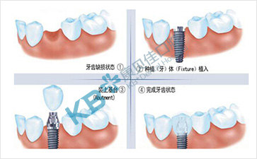 口腔种植修复义齿的步骤