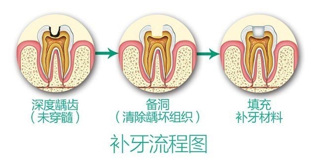 蛀牙补牙多少钱一颗