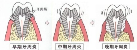 成人有严重牙周病该怎么治疗呢？