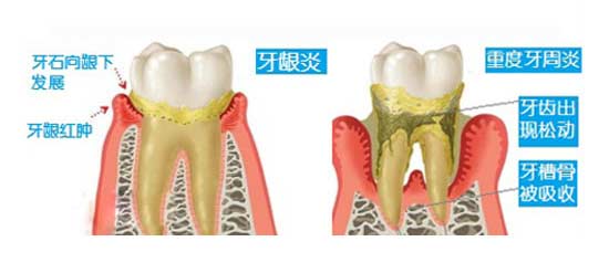怎么缓解牙髓炎的痛 12-1Z62G32034940.jpg