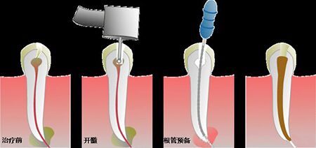 苏州相城区根管治疗多少钱一颗