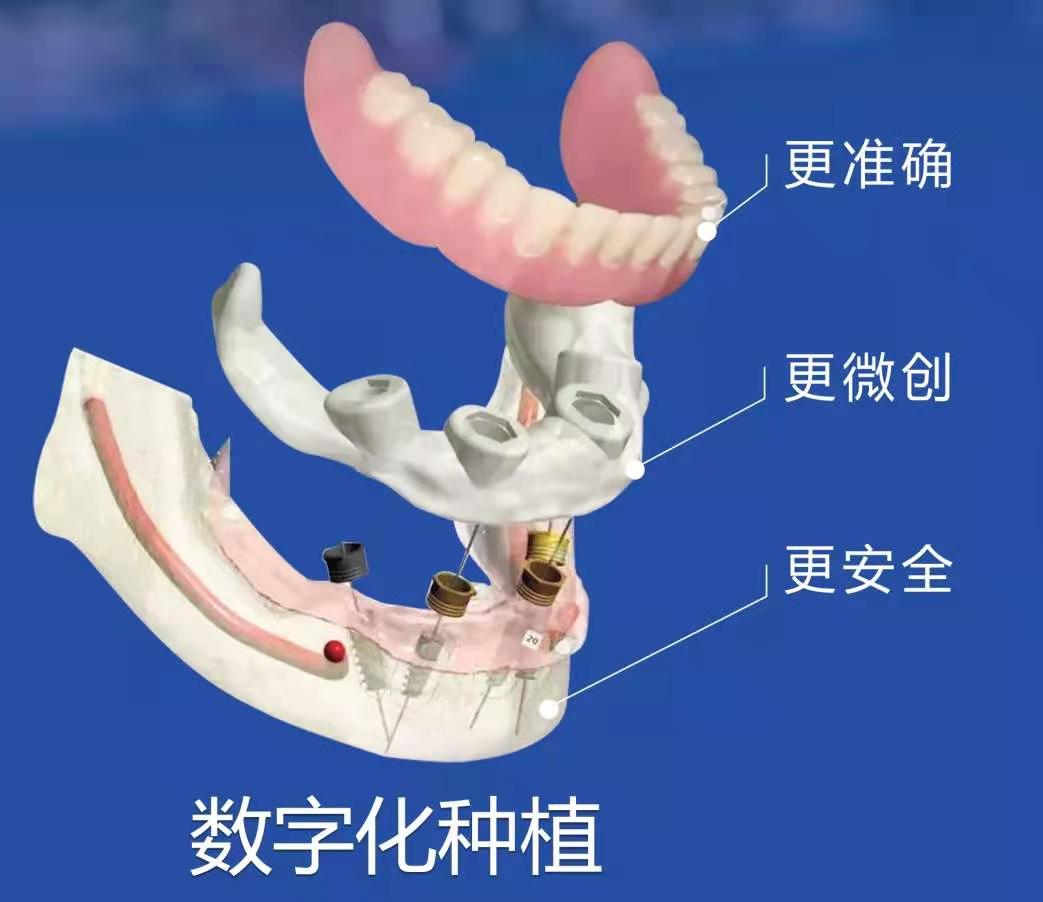 牙科医生告诉你，种植上门牙需小心谨慎 | 升艺口腔医院